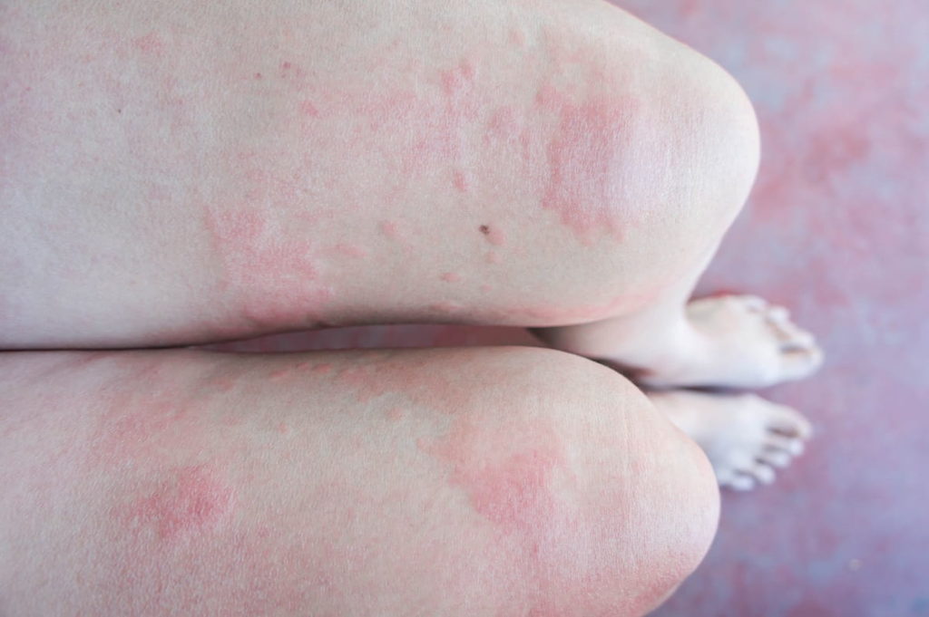 hazards-of-bed-bug-infestation-mr-pest-control