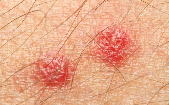 Bite mark, sting or sore on human skin. Close up of symptoms. Healthcare theme.