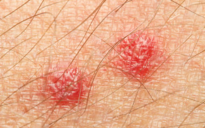 First Aid Tips For Insect Bites Mr Pest Control First Aid Tips For Insect Bites Mr Pest Control
