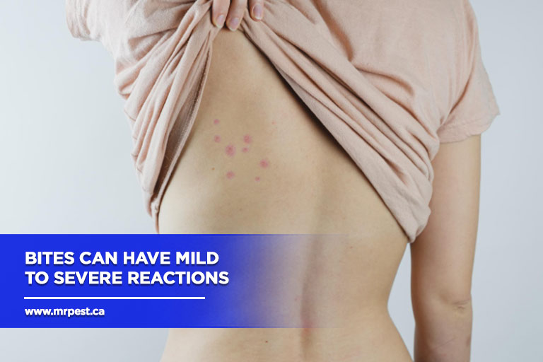 Bites can have mild to severe reactions